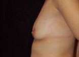 Breast Augmentation, Gel