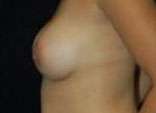 Breast Augmentation, Gel