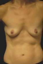 Breast Augmentation, Gel