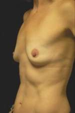 Breast Augmentation, Gel