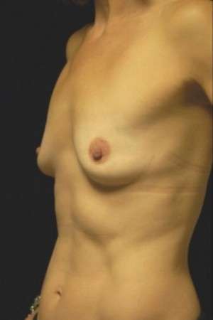 Breast Augmentation, Gel