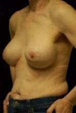 Breast Augmentation, Gel
