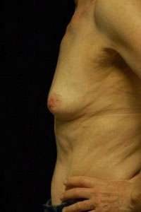 Breast Augmentation, Gel