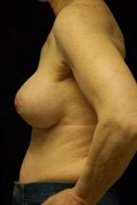 Breast Augmentation, Gel