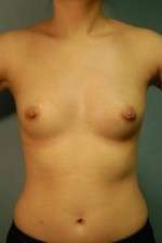 Breast Augmentation, Gel