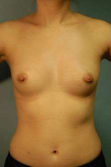 Breast Augmentation, Gel