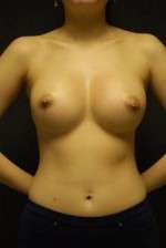 Breast Augmentation, Gel