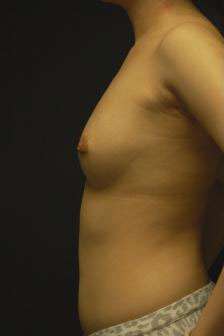 Breast Augmentation, Gel