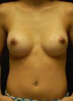 Breast Augmentation Revision