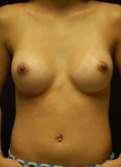 Breast Augmentation Revision