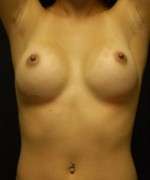 Breast Augmentation Revision
