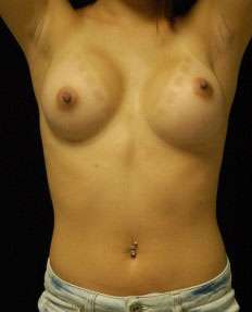 Breast Augmentation Revision