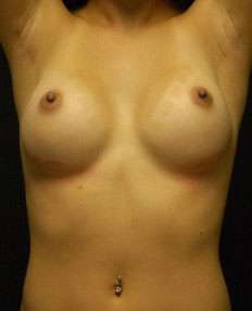 Breast Augmentation Revision