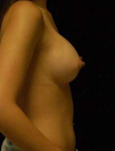 Breast Augmentation Revision