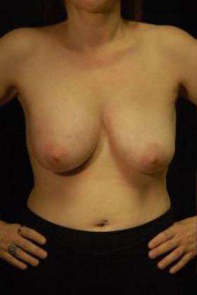 Breast Augmentation Revision