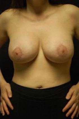Breast Augmentation Revision