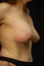 Breast Augmentation Revision