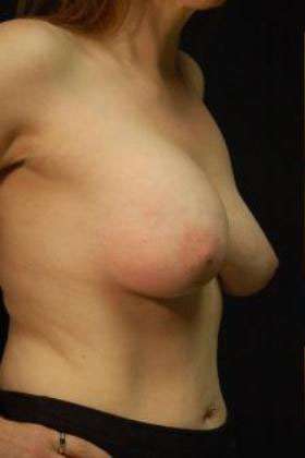Breast Augmentation Revision