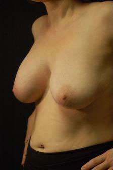 Breast Augmentation Revision