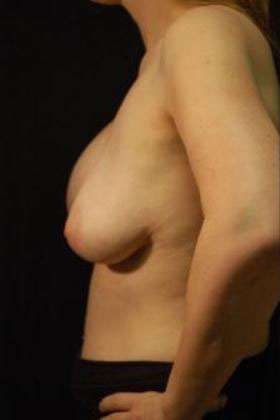 Breast Augmentation Revision