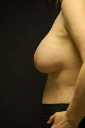 Breast Augmentation Revision