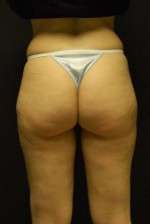 Cellulaze Anti-cellulite Treatment