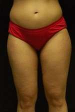Cellulaze Anti-cellulite Treatment