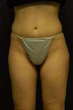 Cellulaze Anti-cellulite Treatment