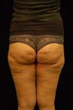 Cellulaze Anti-cellulite Treatment
