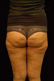 Cellulaze Anti-cellulite Treatment