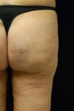 Cellulaze Anti-cellulite Treatment