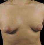 Mastopexy