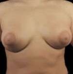 Mastopexy