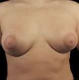 Mastopexy