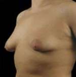 Mastopexy