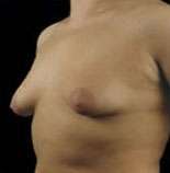 Mastopexy