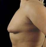 Mastopexy