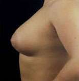 Mastopexy