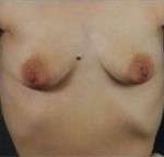 Mastopexy
