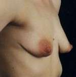 Mastopexy