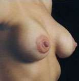 Mastopexy