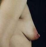 Mastopexy