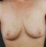 Mastopexy