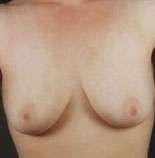 Mastopexy