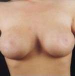 Mastopexy