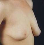 Mastopexy