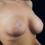 Mastopexy