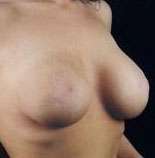 Mastopexy