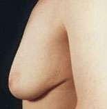 Mastopexy
