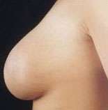 Mastopexy